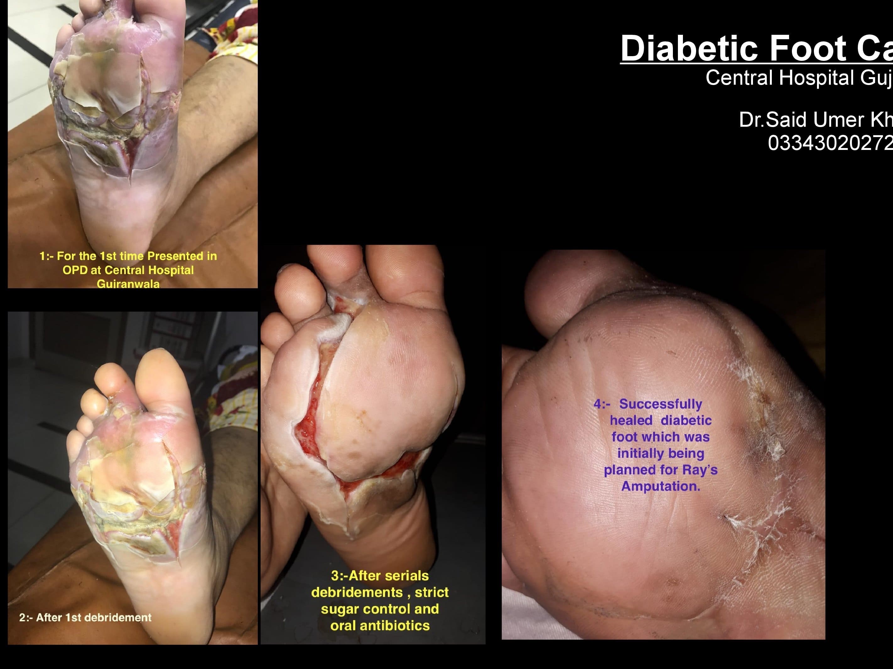 Do not amputate your Diabetic Foot until, if it is necessary to save the patient's life.  Take your time to consult the problem in our clinic.